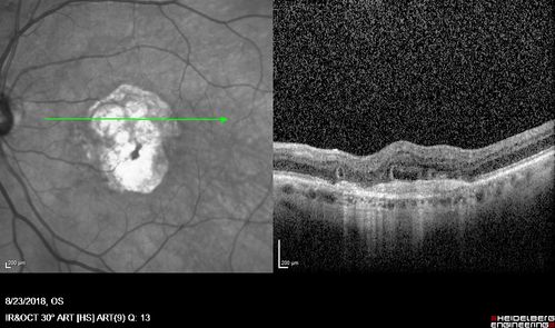 Outer Retinal Tubulation
78 year old man chronic wet AMD - 20/200
