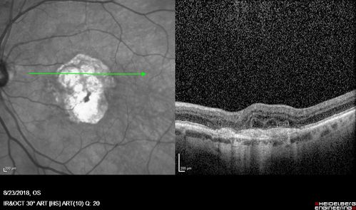 Outer Retinal Tubulation
78 year old man chronic wet AMD - 20/200
