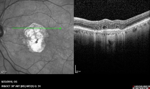 Outer Retinal Tubulation
78 year old man chronic wet AMD - 20/200
