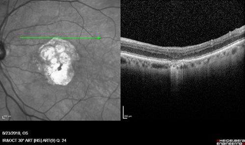 Outer Retinal Tubulation
78 year old man chronic wet AMD - 20/200
