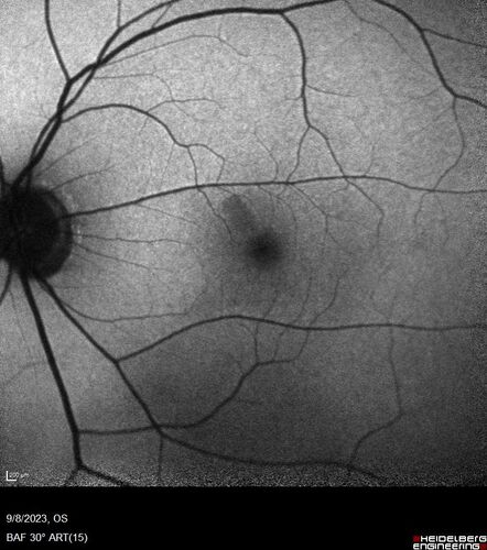 Paracentral acute middle maculopathy - isolated
83 year old man New spot in the vision yesterday left eye.
Medical Hx: Pure Hypercholesterolemia
Systemic Meds: Crestor.
VA OD: Dcc20/20
VA OS: Dcc20/20
IOP: TP: OD:19 OS:10
