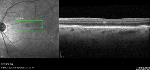 Paracentral acute middle maculopathy - isolated
83 year old man New spot in the vision yesterday left eye.
Medical Hx: Pure Hypercholesterolemia
Systemic Meds: Crestor.
VA OD: Dcc20/20
VA OS: Dcc20/20
IOP: TP: OD:19 OS:10
