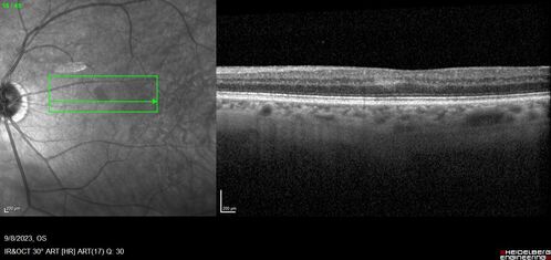 Paracentral acute middle maculopathy - isolated
83 year old man New spot in the vision yesterday left eye.
Medical Hx: Pure Hypercholesterolemia
Systemic Meds: Crestor.
VA OD: Dcc20/20
VA OS: Dcc20/20
IOP: TP: OD:19 OS:10
