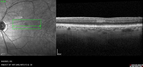 Paracentral acute middle maculopathy - isolated
83 year old man New spot in the vision yesterday left eye.
Medical Hx: Pure Hypercholesterolemia
Systemic Meds: Crestor.
VA OD: Dcc20/20
VA OS: Dcc20/20
IOP: TP: OD:19 OS:10
