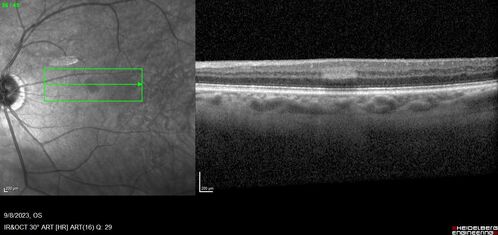 Paracentral acute middle maculopathy - isolated
83 year old man New spot in the vision yesterday left eye.
Medical Hx: Pure Hypercholesterolemia
Systemic Meds: Crestor.
VA OD: Dcc20/20
VA OS: Dcc20/20
IOP: TP: OD:19 OS:10
