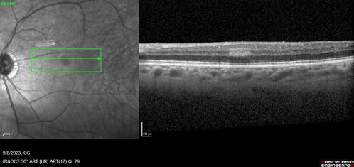 Paracentral acute middle maculopathy - isolated
83 year old man New spot in the vision yesterday left eye.
Medical Hx: Pure Hypercholesterolemia
Systemic Meds: Crestor.
VA OD: Dcc20/20
VA OS: Dcc20/20
IOP: TP: OD:19 OS:10
