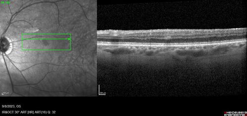 Paracentral acute middle maculopathy - isolated
83 year old man New spot in the vision yesterday left eye.
Medical Hx: Pure Hypercholesterolemia
Systemic Meds: Crestor.
VA OD: Dcc20/20
VA OS: Dcc20/20
IOP: TP: OD:19 OS:10
