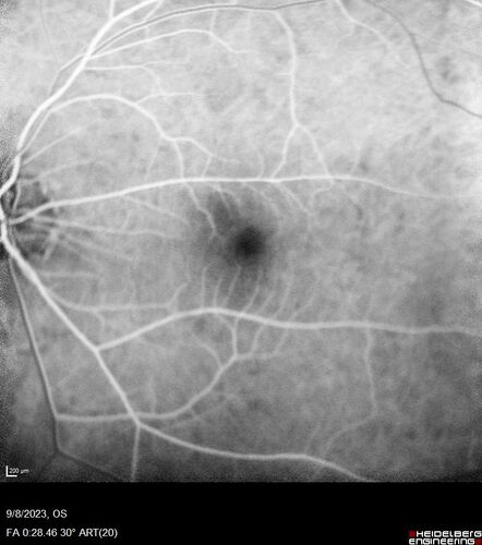 Paracentral acute middle maculopathy - isolated
83 year old man New spot in the vision yesterday left eye.
Medical Hx: Pure Hypercholesterolemia
Systemic Meds: Crestor.
VA OD: Dcc20/20
VA OS: Dcc20/20
IOP: TP: OD:19 OS:10
