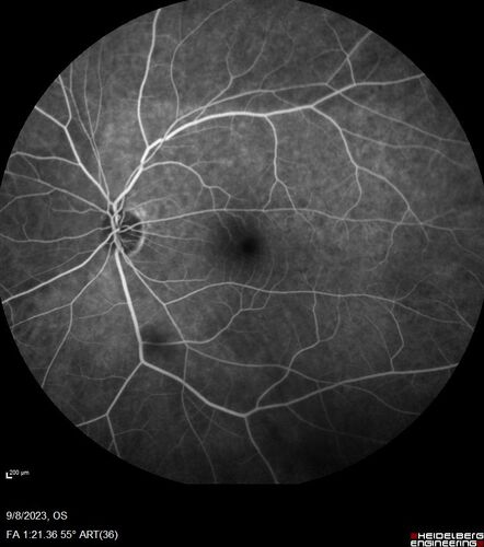 Paracentral acute middle maculopathy - isolated
83 year old man New spot in the vision yesterday left eye.
Medical Hx: Pure Hypercholesterolemia
Systemic Meds: Crestor.
VA OD: Dcc20/20
VA OS: Dcc20/20
IOP: TP: OD:19 OS:10
