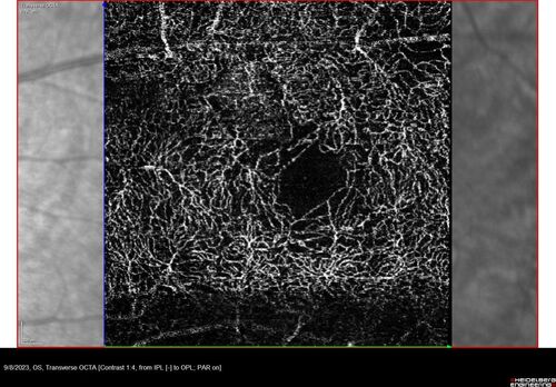 Paracentral acute middle maculopathy - isolated
83 year old man New spot in the vision yesterday left eye.
Medical Hx: Pure Hypercholesterolemia
Systemic Meds: Crestor.
VA OD: Dcc20/20
VA OS: Dcc20/20
IOP: TP: OD:19 OS:10
