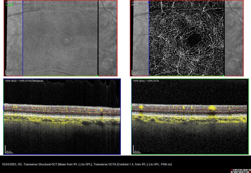 Paracentral acute middle maculopathy - isolated
83 year old man New spot in the vision yesterday left eye.
Medical Hx: Pure Hypercholesterolemia
Systemic Meds: Crestor.
VA OD: Dcc20/20
VA OS: Dcc20/20
IOP: TP: OD:19 OS:10
