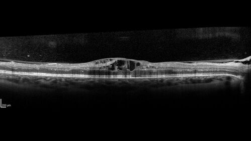 Pregnant - 25 weeks - new onset PDR and DME both eyes - Treated with PRP and ozurdex
29 year old female.  Patient is 25 weeks pregnant and having flare up of retinopathy in both eyes. She states it is worse in the left. Patient has trouble with distant vision.  At most recent visit, 1 years ago, VA was 20/20 OU.  Two years ago anterior uveitis x 1 episode with normal labs (HLAB27, FTA, ACE, Lyme).  2017-2020 â€“ Lucentis for DME left eye only.
PMHx: Type I DM since teenager, hyperlipidemia
BP was normal

