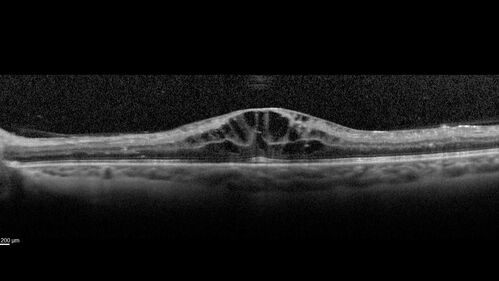 Pregnant - 25 weeks - new onset PDR and DME both eyes - Treated with PRP and ozurdex
29 year old female.  Patient is 25 weeks pregnant and having flare up of retinopathy in both eyes. She states it is worse in the left. Patient has trouble with distant vision.  At most recent visit, 1 years ago, VA was 20/20 OU.  Two years ago anterior uveitis x 1 episode with normal labs (HLAB27, FTA, ACE, Lyme).  2017-2020 â€“ Lucentis for DME left eye only.
PMHx: Type I DM since teenager, hyperlipidemia
BP was normal
