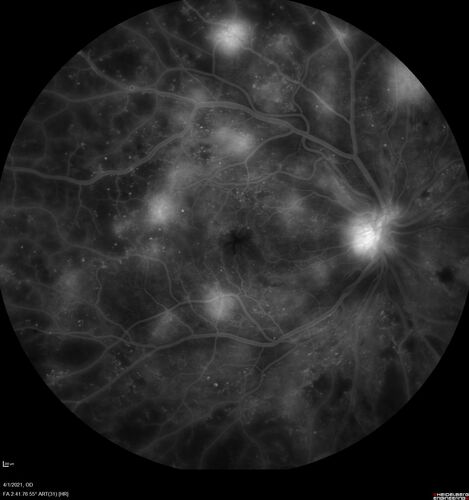 Pregnant - 25 weeks - new onset PDR and DME both eyes - Treated with PRP and ozurdex
29 year old female.  Patient is 25 weeks pregnant and having flare up of retinopathy in both eyes. She states it is worse in the left. Patient has trouble with distant vision.  At most recent visit, 1 years ago, VA was 20/20 OU.  Two years ago anterior uveitis x 1 episode with normal labs (HLAB27, FTA, ACE, Lyme).  2017-2020 â€“ Lucentis for DME left eye only.
PMHx: Type I DM since teenager, hyperlipidemia
BP was normal

