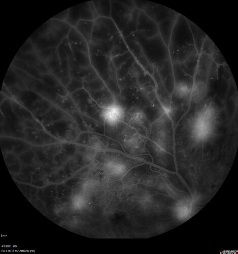 Pregnant - 25 weeks - new onset PDR and DME both eyes - Treated with PRP and ozurdex
29 year old female.  Patient is 25 weeks pregnant and having flare up of retinopathy in both eyes. She states it is worse in the left. Patient has trouble with distant vision.  At most recent visit, 1 years ago, VA was 20/20 OU.  Two years ago anterior uveitis x 1 episode with normal labs (HLAB27, FTA, ACE, Lyme).  2017-2020 â€“ Lucentis for DME left eye only.
PMHx: Type I DM since teenager, hyperlipidemia
BP was normal
