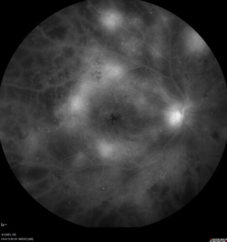Pregnant - 25 weeks - new onset PDR and DME both eyes - Treated with PRP and ozurdex
29 year old female.  Patient is 25 weeks pregnant and having flare up of retinopathy in both eyes. She states it is worse in the left. Patient has trouble with distant vision.  At most recent visit, 1 years ago, VA was 20/20 OU.  Two years ago anterior uveitis x 1 episode with normal labs (HLAB27, FTA, ACE, Lyme).  2017-2020 â€“ Lucentis for DME left eye only.
PMHx: Type I DM since teenager, hyperlipidemia
BP was normal
