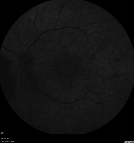 Pregnant - 25 weeks - new onset PDR and DME both eyes - Treated with PRP and ozurdex
29 year old female.  Patient is 25 weeks pregnant and having flare up of retinopathy in both eyes. She states it is worse in the left. Patient has trouble with distant vision.  At most recent visit, 1 years ago, VA was 20/20 OU.  Two years ago anterior uveitis x 1 episode with normal labs (HLAB27, FTA, ACE, Lyme).  2017-2020 â€“ Lucentis for DME left eye only.
PMHx: Type I DM since teenager, hyperlipidemia
BP was normal
