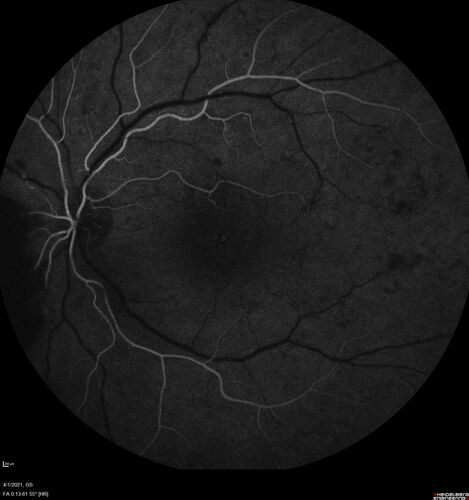 Pregnant - 25 weeks - new onset PDR and DME both eyes - Treated with PRP and ozurdex
29 year old female.  Patient is 25 weeks pregnant and having flare up of retinopathy in both eyes. She states it is worse in the left. Patient has trouble with distant vision.  At most recent visit, 1 years ago, VA was 20/20 OU.  Two years ago anterior uveitis x 1 episode with normal labs (HLAB27, FTA, ACE, Lyme).  2017-2020 â€“ Lucentis for DME left eye only.
PMHx: Type I DM since teenager, hyperlipidemia
BP was normal

