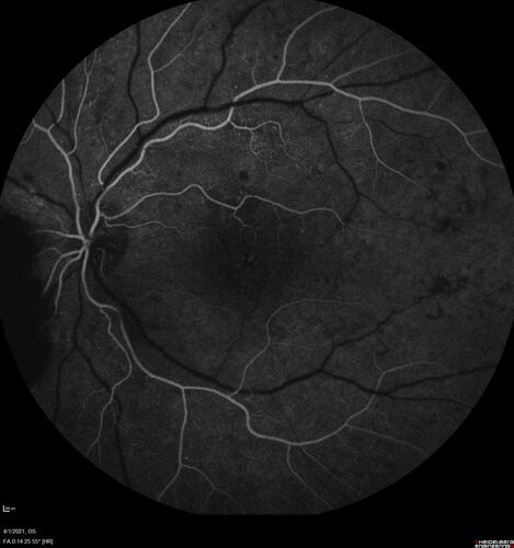 Pregnant - 25 weeks - new onset PDR and DME both eyes - Treated with PRP and ozurdex
29 year old female.  Patient is 25 weeks pregnant and having flare up of retinopathy in both eyes. She states it is worse in the left. Patient has trouble with distant vision.  At most recent visit, 1 years ago, VA was 20/20 OU.  Two years ago anterior uveitis x 1 episode with normal labs (HLAB27, FTA, ACE, Lyme).  2017-2020 â€“ Lucentis for DME left eye only.
PMHx: Type I DM since teenager, hyperlipidemia
BP was normal

