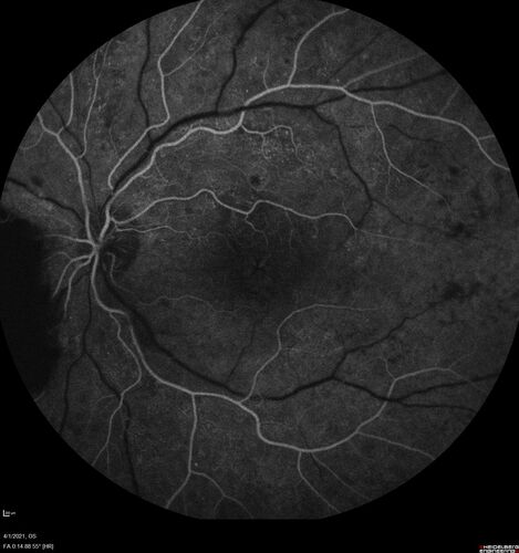 Pregnant - 25 weeks - new onset PDR and DME both eyes - Treated with PRP and ozurdex
29 year old female.  Patient is 25 weeks pregnant and having flare up of retinopathy in both eyes. She states it is worse in the left. Patient has trouble with distant vision.  At most recent visit, 1 years ago, VA was 20/20 OU.  Two years ago anterior uveitis x 1 episode with normal labs (HLAB27, FTA, ACE, Lyme).  2017-2020 â€“ Lucentis for DME left eye only.
PMHx: Type I DM since teenager, hyperlipidemia
BP was normal
