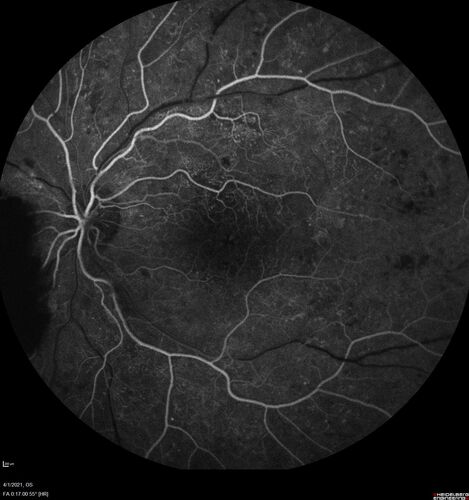 Pregnant - 25 weeks - new onset PDR and DME both eyes - Treated with PRP and ozurdex
29 year old female.  Patient is 25 weeks pregnant and having flare up of retinopathy in both eyes. She states it is worse in the left. Patient has trouble with distant vision.  At most recent visit, 1 years ago, VA was 20/20 OU.  Two years ago anterior uveitis x 1 episode with normal labs (HLAB27, FTA, ACE, Lyme).  2017-2020 â€“ Lucentis for DME left eye only.
PMHx: Type I DM since teenager, hyperlipidemia
BP was normal
