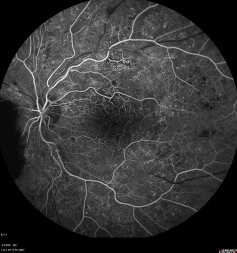 Pregnant - 25 weeks - new onset PDR and DME both eyes - Treated with PRP and ozurdex
29 year old female.  Patient is 25 weeks pregnant and having flare up of retinopathy in both eyes. She states it is worse in the left. Patient has trouble with distant vision.  At most recent visit, 1 years ago, VA was 20/20 OU.  Two years ago anterior uveitis x 1 episode with normal labs (HLAB27, FTA, ACE, Lyme).  2017-2020 â€“ Lucentis for DME left eye only.
PMHx: Type I DM since teenager, hyperlipidemia
BP was normal
