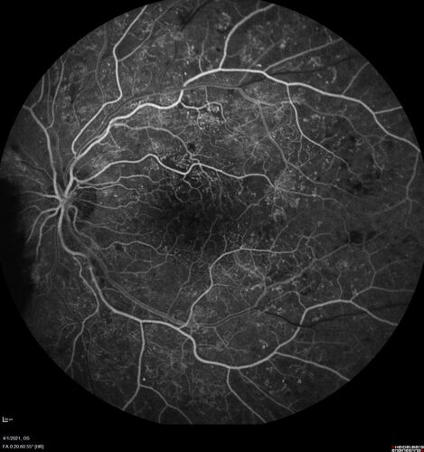 Pregnant - 25 weeks - new onset PDR and DME both eyes - Treated with PRP and ozurdex
29 year old female.  Patient is 25 weeks pregnant and having flare up of retinopathy in both eyes. She states it is worse in the left. Patient has trouble with distant vision.  At most recent visit, 1 years ago, VA was 20/20 OU.  Two years ago anterior uveitis x 1 episode with normal labs (HLAB27, FTA, ACE, Lyme).  2017-2020 â€“ Lucentis for DME left eye only.
PMHx: Type I DM since teenager, hyperlipidemia
BP was normal
