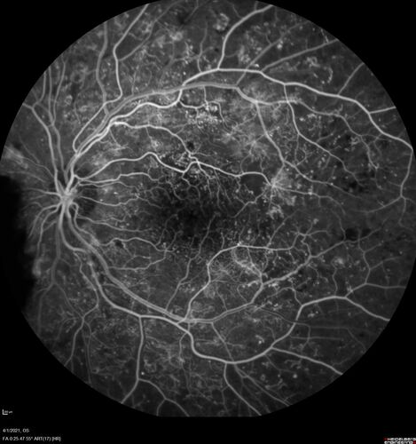 Pregnant - 25 weeks - new onset PDR and DME both eyes - Treated with PRP and ozurdex
29 year old female.  Patient is 25 weeks pregnant and having flare up of retinopathy in both eyes. She states it is worse in the left. Patient has trouble with distant vision.  At most recent visit, 1 years ago, VA was 20/20 OU.  Two years ago anterior uveitis x 1 episode with normal labs (HLAB27, FTA, ACE, Lyme).  2017-2020 â€“ Lucentis for DME left eye only.
PMHx: Type I DM since teenager, hyperlipidemia
BP was normal
