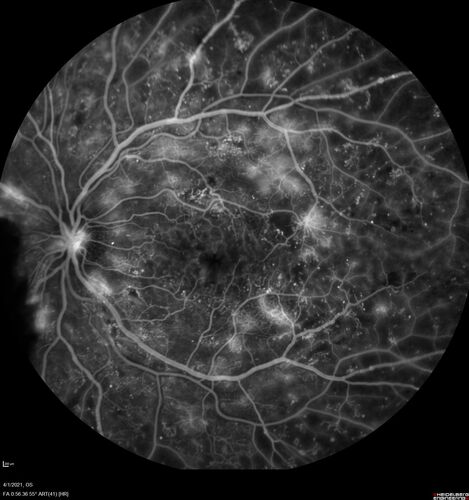Pregnant - 25 weeks - new onset PDR and DME both eyes - Treated with PRP and ozurdex
29 year old female.  Patient is 25 weeks pregnant and having flare up of retinopathy in both eyes. She states it is worse in the left. Patient has trouble with distant vision.  At most recent visit, 1 years ago, VA was 20/20 OU.  Two years ago anterior uveitis x 1 episode with normal labs (HLAB27, FTA, ACE, Lyme).  2017-2020 â€“ Lucentis for DME left eye only.
PMHx: Type I DM since teenager, hyperlipidemia
BP was normal
