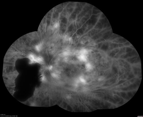 Pregnant - 25 weeks - new onset PDR and DME both eyes - Treated with PRP and ozurdex
29 year old female.  Patient is 25 weeks pregnant and having flare up of retinopathy in both eyes. She states it is worse in the left. Patient has trouble with distant vision.  At most recent visit, 1 years ago, VA was 20/20 OU.  Two years ago anterior uveitis x 1 episode with normal labs (HLAB27, FTA, ACE, Lyme).  2017-2020 â€“ Lucentis for DME left eye only.
PMHx: Type I DM since teenager, hyperlipidemia
BP was normal
