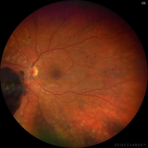 Pregnant - 25 weeks - new onset PDR and DME both eyes - Treated with PRP and ozurdex
29 year old female.  Patient is 25 weeks pregnant and having flare up of retinopathy in both eyes. She states it is worse in the left. Patient has trouble with distant vision.  At most recent visit, 1 years ago, VA was 20/20 OU.  Two years ago anterior uveitis x 1 episode with normal labs (HLAB27, FTA, ACE, Lyme).  2017-2020 â€“ Lucentis for DME left eye only.
PMHx: Type I DM since teenager, hyperlipidemia
BP was normal
