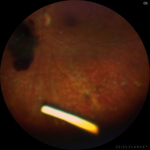 Pregnant - 25 weeks - new onset PDR and DME both eyes - Treated with PRP and ozurdex
29 year old female.  Patient is 25 weeks pregnant and having flare up of retinopathy in both eyes. She states it is worse in the left. Patient has trouble with distant vision.  At most recent visit, 1 years ago, VA was 20/20 OU.  Two years ago anterior uveitis x 1 episode with normal labs (HLAB27, FTA, ACE, Lyme).  2017-2020 â€“ Lucentis for DME left eye only.
PMHx: Type I DM since teenager, hyperlipidemia
BP was normal
