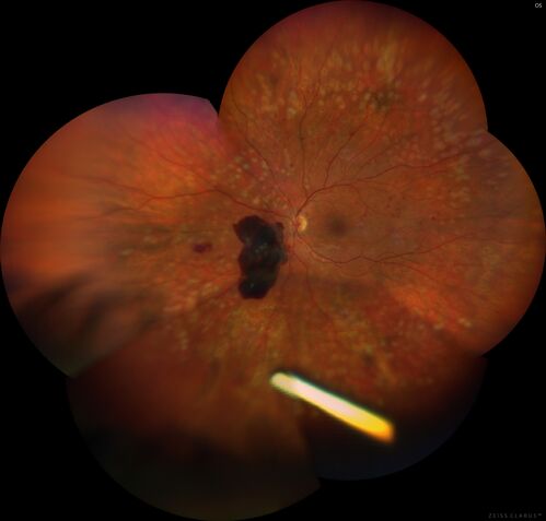 Pregnant - 25 weeks - new onset PDR and DME both eyes - Treated with PRP and ozurdex
29 year old female.  Patient is 25 weeks pregnant and having flare up of retinopathy in both eyes. She states it is worse in the left. Patient has trouble with distant vision.  At most recent visit, 1 years ago, VA was 20/20 OU.  Two years ago anterior uveitis x 1 episode with normal labs (HLAB27, FTA, ACE, Lyme).  2017-2020 â€“ Lucentis for DME left eye only.
PMHx: Type I DM since teenager, hyperlipidemia
BP was normal

