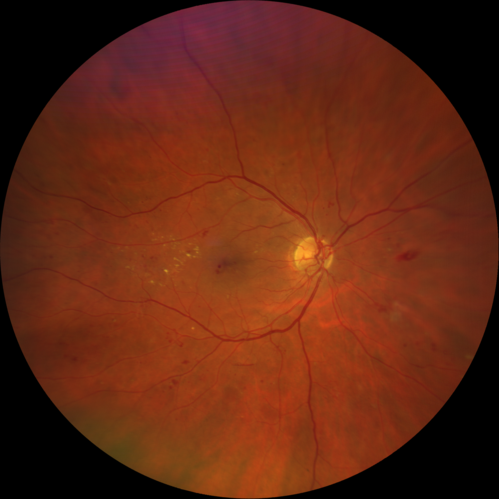PDR and DME and VH
57 year old diabetic man with vision loss in the left eye for several months.  He has DME in the left eye and VH in the left eye and PDR in both eyes.  He has been started in the left eye on Anti-VEGF therapy. VA on presentation was 20/25 OD and 20/200 OS
