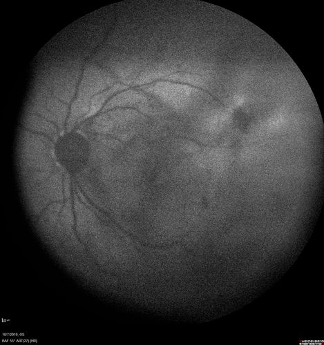 PDR and DME and VH
57 year old diabetic man with vision loss in the left eye for several months.  He has DME in the left eye and VH in the left eye and PDR in both eyes.  He has been started in the left eye on Anti-VEGF therapy. VA on presentation was 20/25 OD and 20/200 OS
