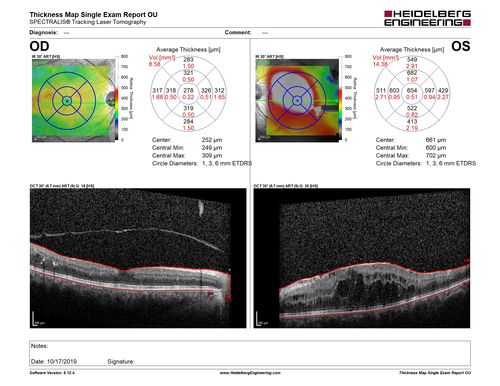 PDR and DME and VH
57 year old diabetic man with vision loss in the left eye for several months.  He has DME in the left eye and VH in the left eye and PDR in both eyes.  He has been started in the left eye on Anti-VEGF therapy. VA on presentation was 20/25 OD and 20/200 OS
