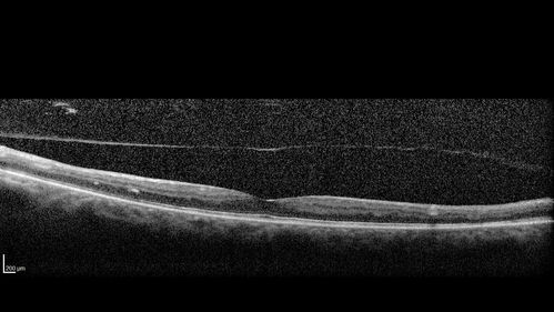 PDR and DME and VH
57 year old diabetic man with vision loss in the left eye for several months.  He has DME in the left eye and VH in the left eye and PDR in both eyes.  He has been started in the left eye on Anti-VEGF therapy. VA on presentation was 20/25 OD and 20/200 OS
