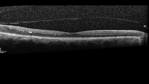 PDR and DME and VH
57 year old diabetic man with vision loss in the left eye for several months.  He has DME in the left eye and VH in the left eye and PDR in both eyes.  He has been started in the left eye on Anti-VEGF therapy. VA on presentation was 20/25 OD and 20/200 OS
