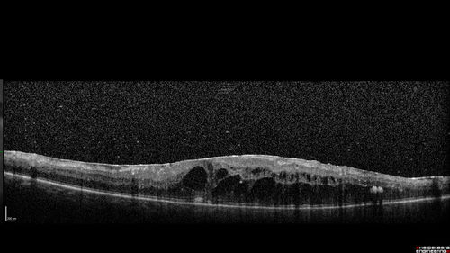 PDR and DME and VH
57 year old diabetic man with vision loss in the left eye for several months.  He has DME in the left eye and VH in the left eye and PDR in both eyes.  He has been started in the left eye on Anti-VEGF therapy. VA on presentation was 20/25 OD and 20/200 OS
