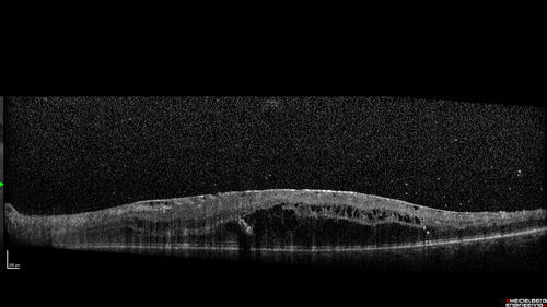 PDR and DME and VH
57 year old diabetic man with vision loss in the left eye for several months.  He has DME in the left eye and VH in the left eye and PDR in both eyes.  He has been started in the left eye on Anti-VEGF therapy. VA on presentation was 20/25 OD and 20/200 OS
