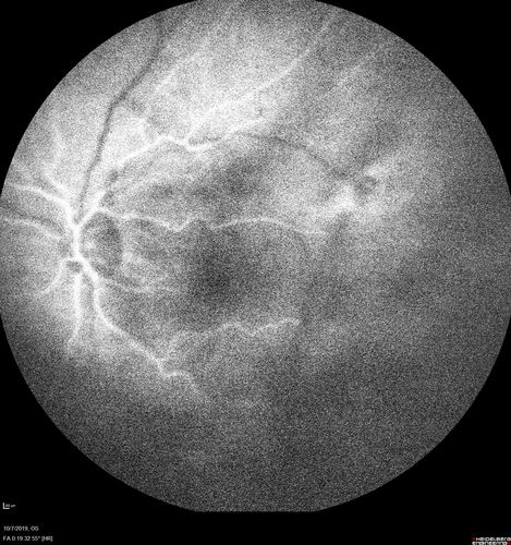 PDR and DME and VH
57 year old diabetic man with vision loss in the left eye for several months.  He has DME in the left eye and VH in the left eye and PDR in both eyes.  He has been started in the left eye on Anti-VEGF therapy. VA on presentation was 20/25 OD and 20/200 OS

