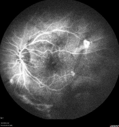 PDR and DME and VH
57 year old diabetic man with vision loss in the left eye for several months.  He has DME in the left eye and VH in the left eye and PDR in both eyes.  He has been started in the left eye on Anti-VEGF therapy. VA on presentation was 20/25 OD and 20/200 OS
