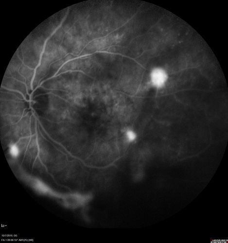 PDR and DME and VH
57 year old diabetic man with vision loss in the left eye for several months.  He has DME in the left eye and VH in the left eye and PDR in both eyes.  He has been started in the left eye on Anti-VEGF therapy. VA on presentation was 20/25 OD and 20/200 OS
