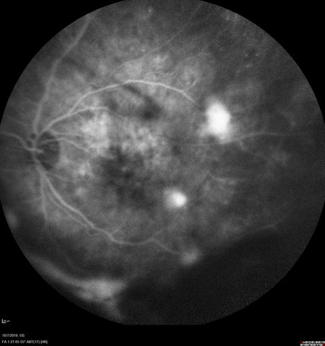 PDR and DME and VH
57 year old diabetic man with vision loss in the left eye for several months.  He has DME in the left eye and VH in the left eye and PDR in both eyes.  He has been started in the left eye on Anti-VEGF therapy. VA on presentation was 20/25 OD and 20/200 OS
