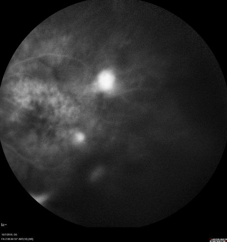 PDR and DME and VH
57 year old diabetic man with vision loss in the left eye for several months.  He has DME in the left eye and VH in the left eye and PDR in both eyes.  He has been started in the left eye on Anti-VEGF therapy. VA on presentation was 20/25 OD and 20/200 OS
