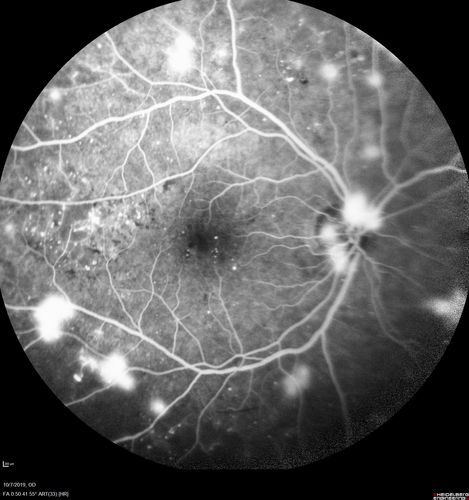 PDR and DME and VH
57 year old diabetic man with vision loss in the left eye for several months.  He has DME in the left eye and VH in the left eye and PDR in both eyes.  He has been started in the left eye on Anti-VEGF therapy. VA on presentation was 20/25 OD and 20/200 OS
