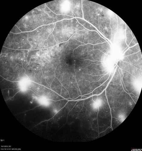 PDR and DME and VH
57 year old diabetic man with vision loss in the left eye for several months.  He has DME in the left eye and VH in the left eye and PDR in both eyes.  He has been started in the left eye on Anti-VEGF therapy. VA on presentation was 20/25 OD and 20/200 OS
