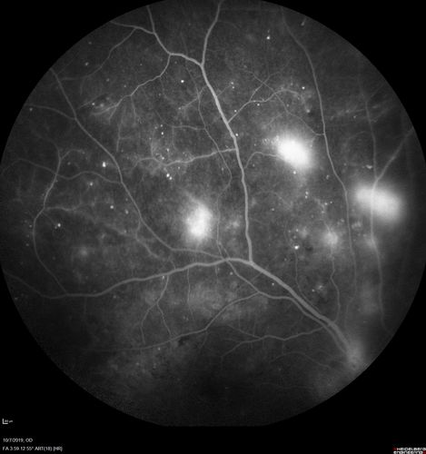 PDR and DME and VH
57 year old diabetic man with vision loss in the left eye for several months.  He has DME in the left eye and VH in the left eye and PDR in both eyes.  He has been started in the left eye on Anti-VEGF therapy. VA on presentation was 20/25 OD and 20/200 OS
