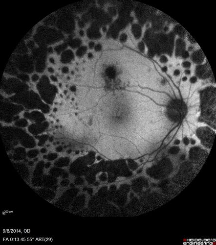 Proliferative Diabetic Retinopathy with Panretinal Photocoagulation
57 year old female Type 1 DM with prior laser about 10 years ago in Chicago.
HTN, Thyroid cancer and removal, Cardiovascular disease
Meds: ASA 325 mg /day, etc
Recent new floaters in the right eye:

VA 20/50 OD, 20/40 OS
