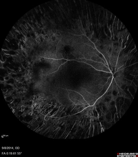 Proliferative Diabetic Retinopathy with Panretinal Photocoagulation
57 year old female Type 1 DM with prior laser about 10 years ago in Chicago.
HTN, Thyroid cancer and removal, Cardiovascular disease
Meds: ASA 325 mg /day, etc
Recent new floaters in the right eye:

VA 20/50 OD, 20/40 OS
